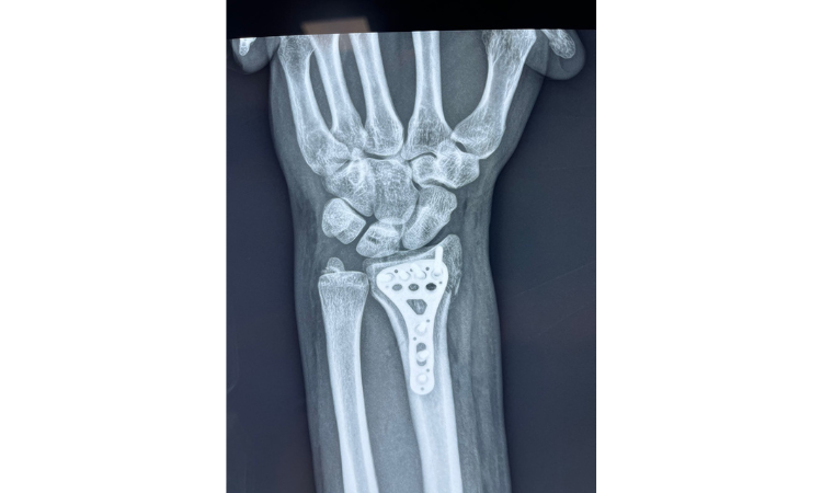 Fractura de mano y muñeca