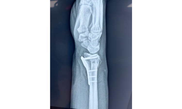 Fractura de mano y muñeca