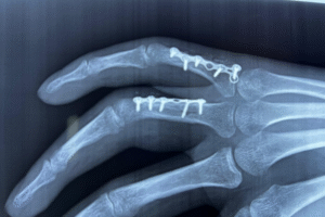 Fracturas de los Dedos de la Mano y Huesos del Carpo